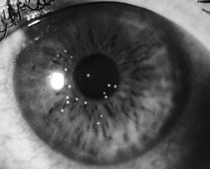 Adenovirus Keratitis